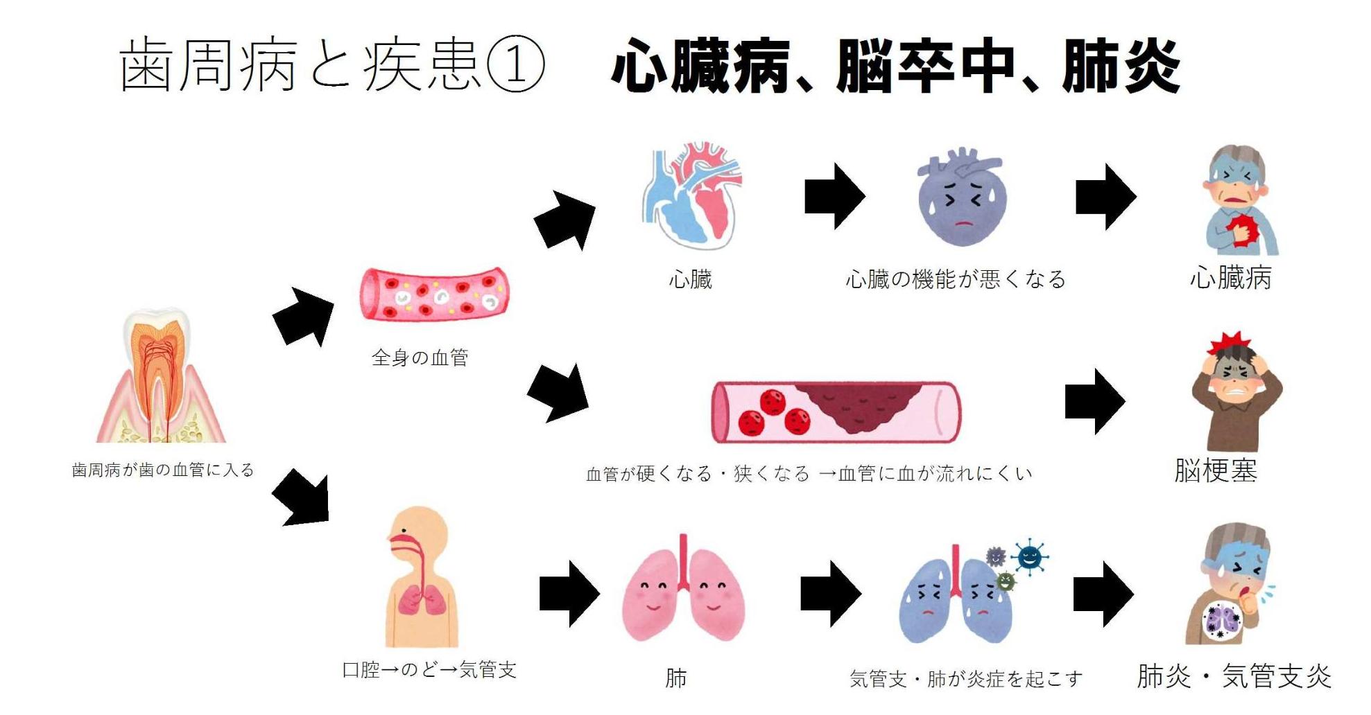 歯周病と全身の疾患